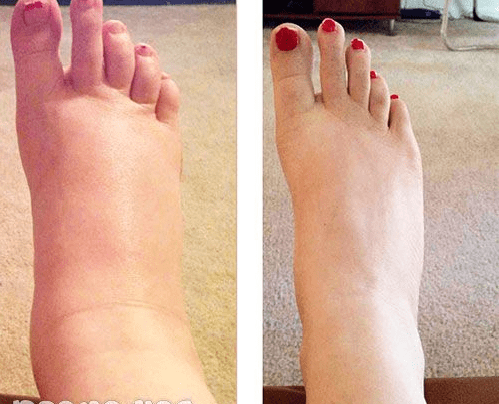 vicks on cracked heels